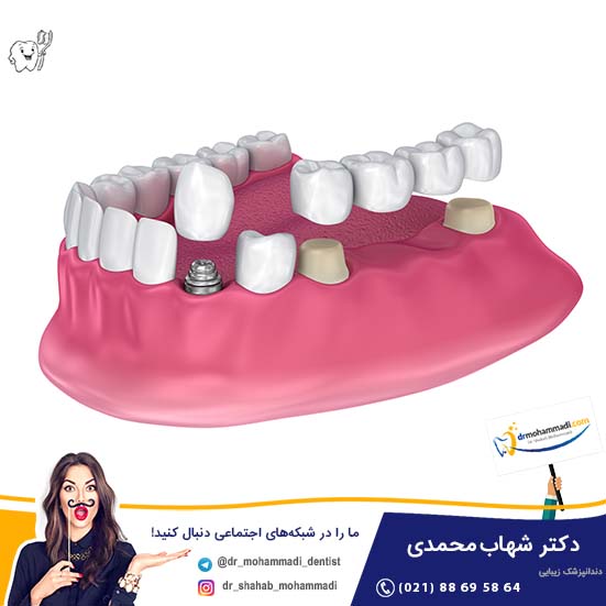 بریج سنتی یا ایمپلنت دندان: کدام بهتر است؟ - کلینیک دندانپزشکی دکتر شهاب محمدی